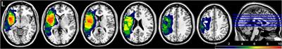 Therapy-Induced Neuroplasticity of Language in Chronic Post Stroke Aphasia: A Mismatch Negativity Study of (A)Grammatical and Meaningful/less Mini-Constructions